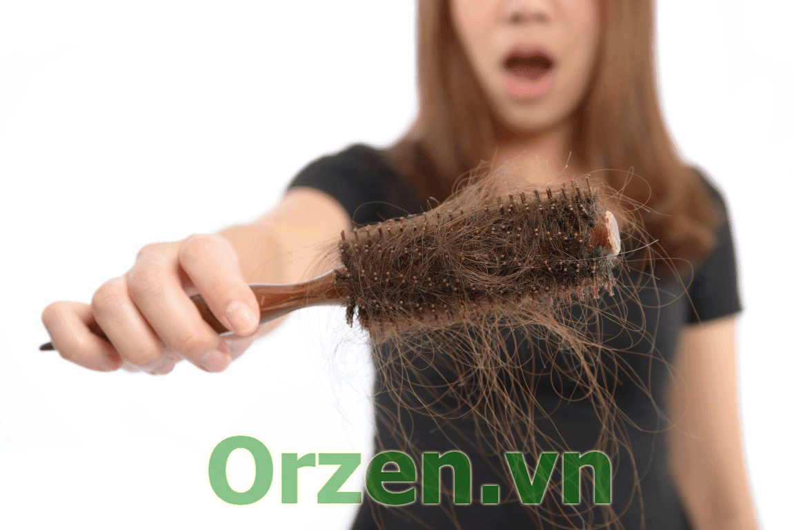 rụng tóc nhiều thường sảy ra ở phụ nữ sau sinh